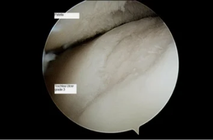 kind of stellarscope in the knee joint with osteoarthritis of the 3-th degree