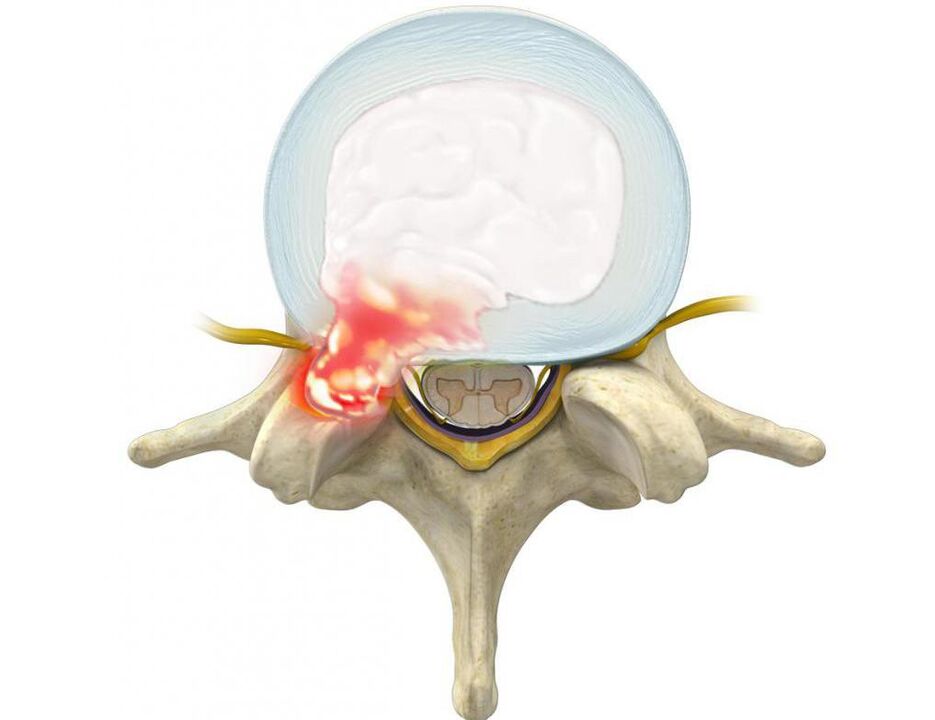 A damaged disc causes back pain