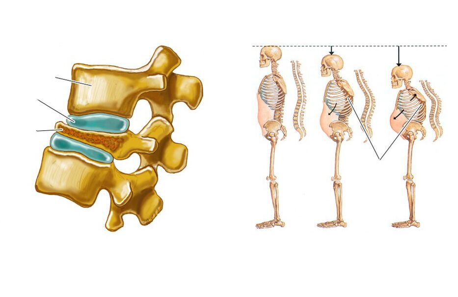 Allowed spine causes back pain