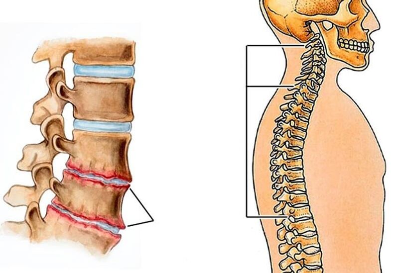 Spinal curvature causes back pain