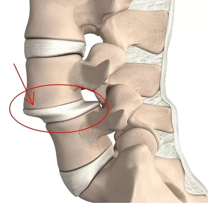 Spinal injuries