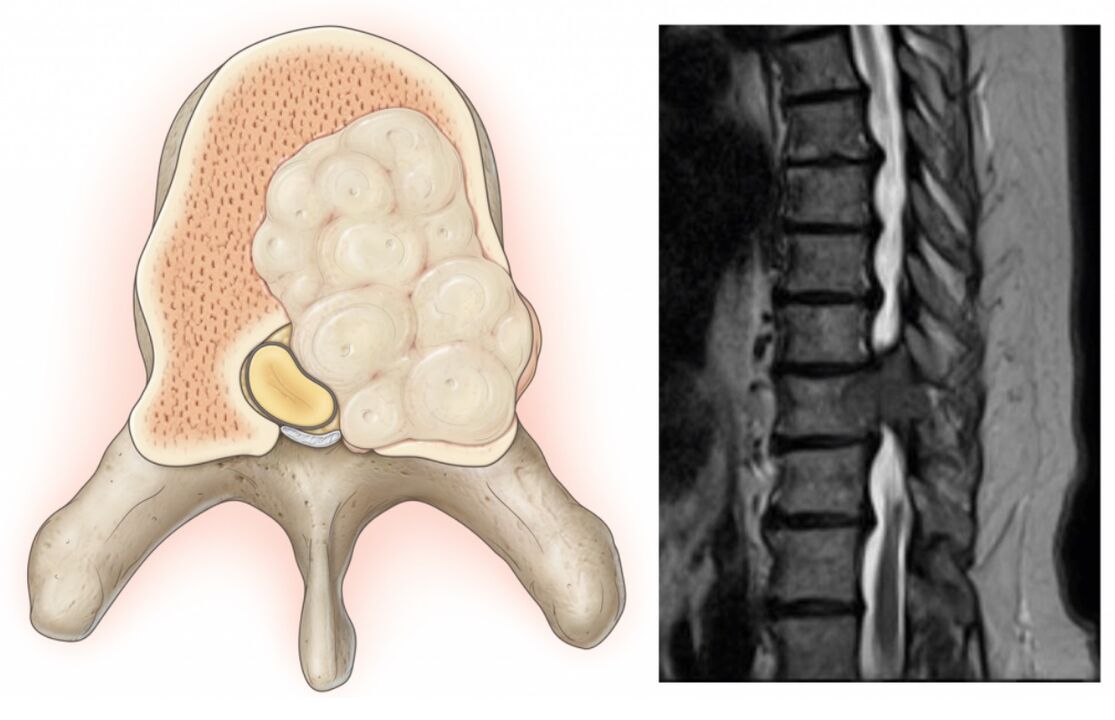 Swelling of the spine causes back pain