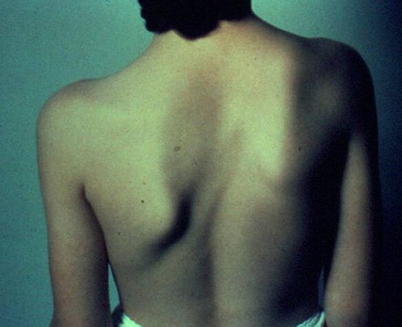 Sprangel disease as a cause of pain in the left shoulder