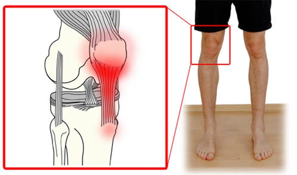 Tendinitis - Inflammation of the tendons of the knee joint