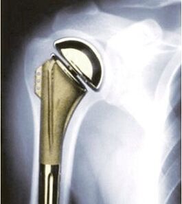 Shoulder prosthetics for osteoarthritis