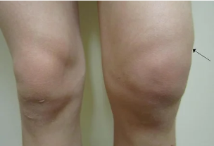 Hemarthrosis knee