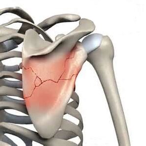 Scapula fracture is one of the causes of severe pain