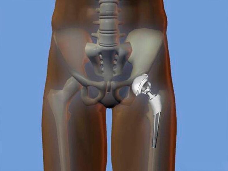 Hip arthroplasty for pain