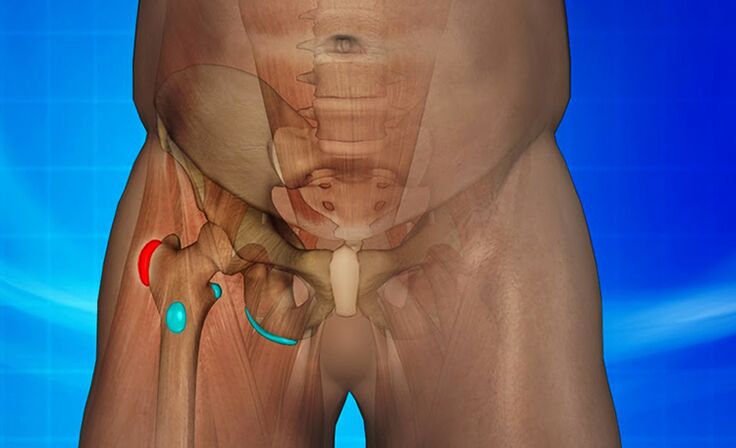 Inflammation of the hip joint as a cause of pain