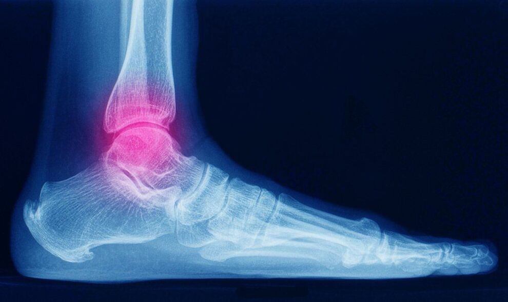 Symptoms of ankle arthrosis