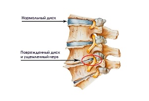 The symptoms of cervical degenerative disc disease.