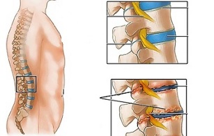 Causes of lumbar spine osteochondrosis