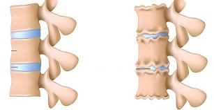 How to detect the presence of osteochondrosis of the lumbar spine