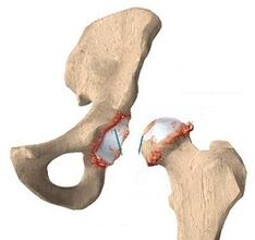 Causes of hip arthrosis