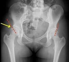 Methods of treatment of osteoarthritis of the hip joint