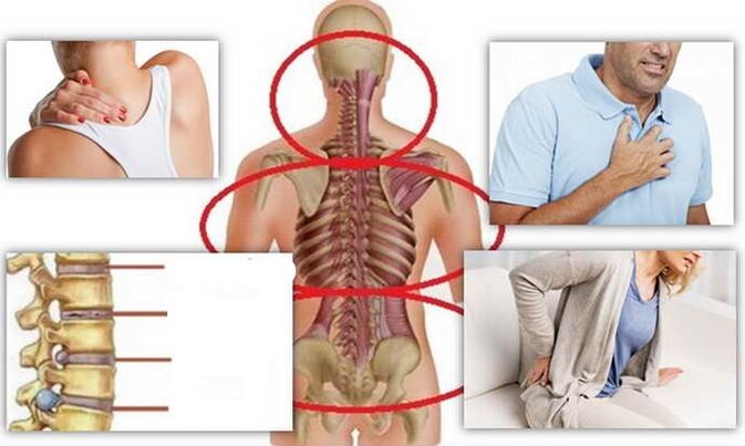 Places of osteochondrosis disease