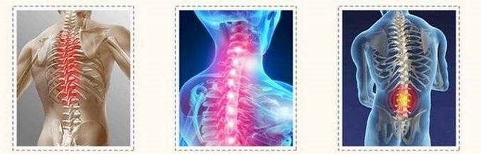 Spinal cord injury with osteochondrosis