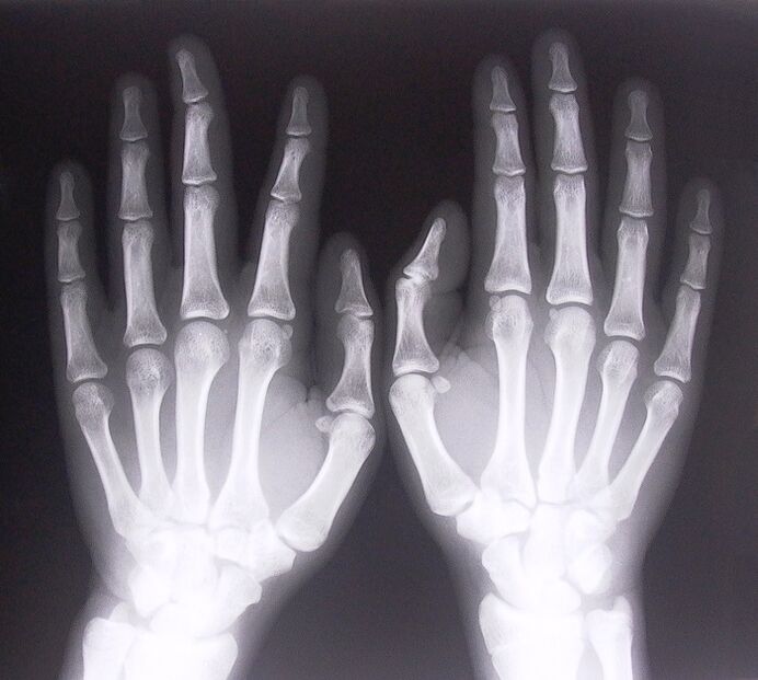 X-ray as a means of diagnosing pain in the joints of the fingers